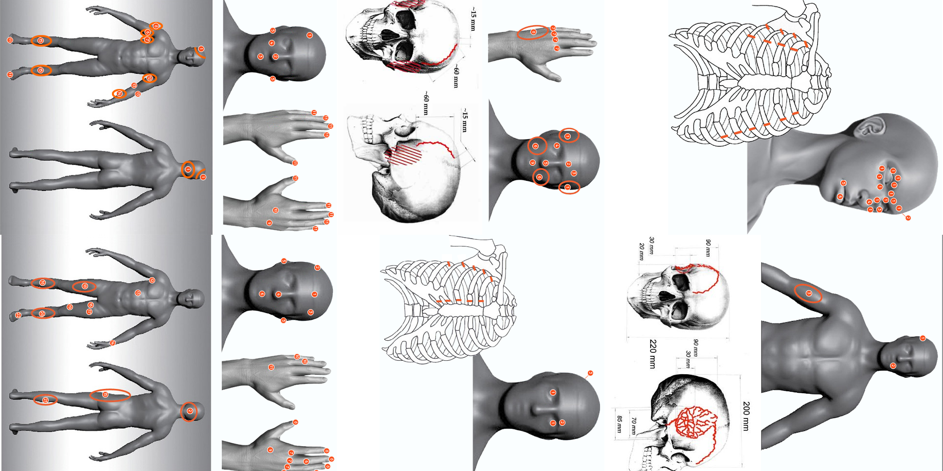 Distribución de lesiones internas documentadas en el Paso Dyatlov