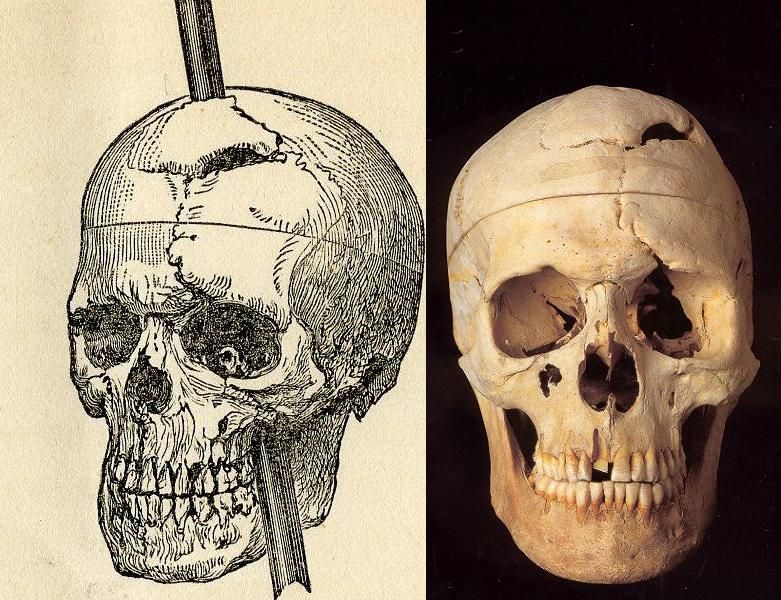 Trayectoria de la barra de hierro en el cráneo de Phineas Gage